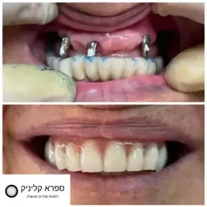 שיקום על גבי שתלים שיניים קדמיות